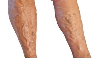 Zdravljenje krčnih žil v nogah