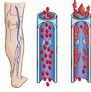 Kako izgledata normalna vena in vena pri krčnih žilah