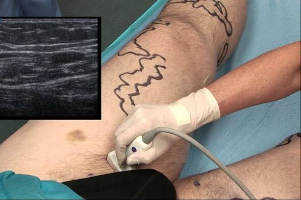 diagnoza krčnih žil pri moških