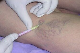 skleroterapija kot metoda zdravljenja krčnih žil
