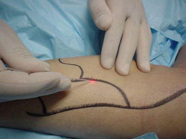 lasersko zdravljenje krčnih žil