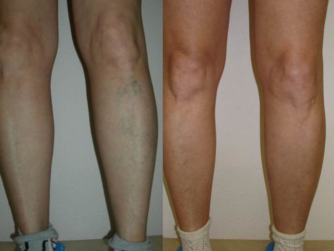 noge pred in po laserskem zdravljenju krčnih žil