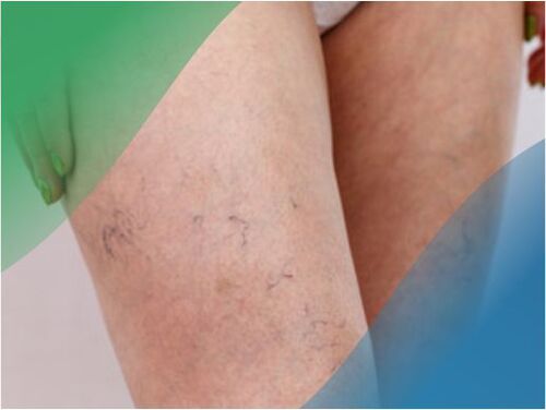 Žilna mreža na nogah je eden od simptomov krčnih žil