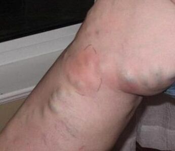 Tromboflebitis na nogi s krčnimi žilami