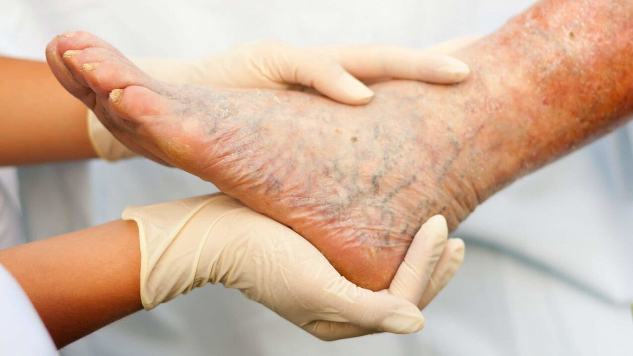 Flebolog se ukvarja z zdravljenjem krčnih žil na nogah
