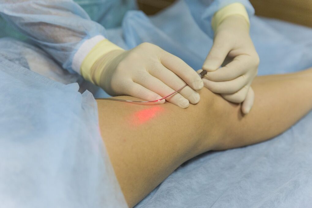 Lasersko zdravljenje krčnih žil spodnjih okončin