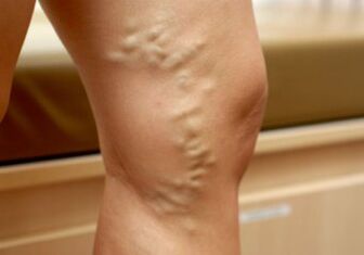 Krčne žile na ženskih nogah