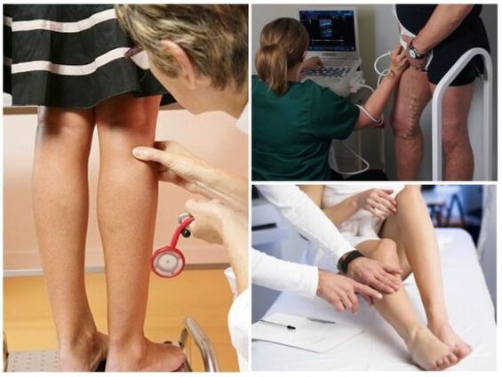 Diagnoza krčnih žil